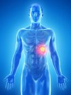 Рак селезінки в чоловічому тілі, концептуальна комп'ютерна ілюстрація. — стокове фото