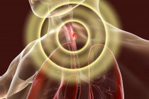 Cancro esofageo nel corpo maschile, illustrazione digitale astratta . — Foto stock