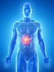Рак підшлункової залози в чоловічому тілі, концептуальний комп'ютерний приклад. — стокове фото