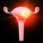 Tumore uterino, illustrazione concettuale del computer . — Foto stock