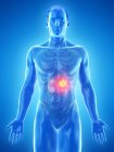 Cancro ai reni nel corpo maschile, illustrazione digitale concettuale . — Foto stock