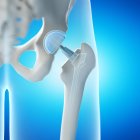 Ortopedia reemplazo de cadera sobre fondo azul, ilustración digital . - foto de stock