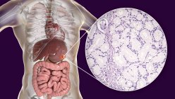 Adenocarcinoma mucinoso del estómago humano, ilustración por computadora y micrografía ligera . - foto de stock