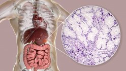 Adenocarcinoma mucinoso del estómago humano, ilustración por computadora y micrografía ligera . - foto de stock