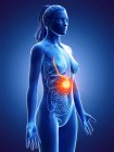 Cancer de l'estomac dans le corps féminin, illustration conceptuelle par ordinateur . — Photo de stock