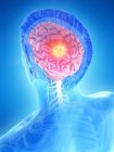 Tumeur cérébrale dans le corps masculin, illustration conceptuelle par ordinateur . — Photo de stock