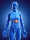 Женское тело с раком надпочечников, компьютерная иллюстрация . — стоковое фото