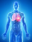 Рак легенів в анатомії чоловічого тіла, комп'ютерна ілюстрація . — стокове фото