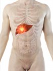Câncer de fígado na silhueta do corpo masculino, ilustração digital . — Fotografia de Stock