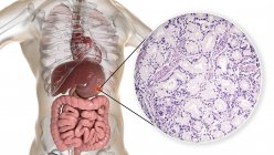 Манінозний аденокарцинома шлунка людини, комп'ютерна ілюстрація та легкий мікрограф . — стокове фото