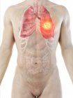 Cancer du poumon dans l'anatomie du corps masculin, illustration par ordinateur . — Photo de stock