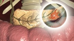 Цифровая иллюстрация показывает злокачественный рост поджелудочной железы при раке поджелудочной железы . — стоковое фото