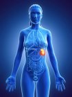 Spleen cancer in female body, computer illustration. — Stock Photo