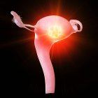 Tumor uterino, ilustración conceptual por ordenador . - foto de stock