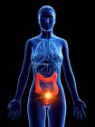 Silueta femenina con cáncer en el intestino grueso, ilustración digital . - foto de stock