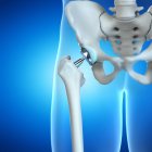 Ortopedia anca sostituzione su sfondo blu, illustrazione digitale . — Foto stock