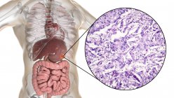Human stomach mucinous adenocarcinoma, computer illustration and light micrograph. — Stock Photo