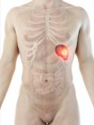 Spleen cancer in male body, conceptual computer illustration. — Stock Photo