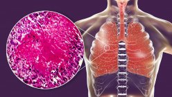 Malattia ausiliaria della tubercolosi nei polmoni, illustrazione digitale e micrografo leggero
. — Foto stock