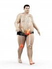 Silhouette dell'uomo obeso che cammina con dolore articolare, illustrazione al computer . — Foto stock