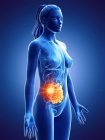 Silueta femenina con cáncer en el intestino delgado, ilustración digital . - foto de stock