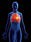 Tumor pulmonar en el cuerpo femenino sobre fondo azul, ilustración digital . - foto de stock