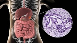 Adenocarcinoma de estómago humano, ilustración por computadora y micrografía ligera . - foto de stock