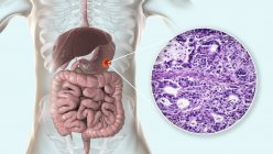 Adenocarcinoma de estómago humano, ilustración por computadora y micrografía ligera . - foto de stock