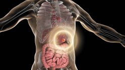 Traitement du cancer de l'estomac humain, illustration conceptuelle par ordinateur . — Photo de stock