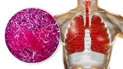 Милиарное заболевание туберкулеза в легких, цифровая иллюстрация и световой микрограф
. — стоковое фото