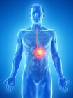 Stomach cancer in abstract male body, digital illustration. — Stock Photo