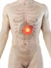 Magenkrebs im abstrakten männlichen Körper, digitale Illustration. — Stockfoto
