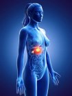 Cuerpo femenino con cáncer de glándulas suprarrenales, ilustración por computadora . - foto de stock