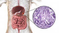Adenocarcinoma dello stomaco umano, illustrazione al computer e micrografo leggero . — Foto stock