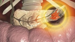 Цифровая иллюстрация показывает злокачественный рост поджелудочной железы при раке поджелудочной железы . — стоковое фото