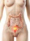 Darmkrebs im weiblichen Körper, konzeptionelle Computerillustration. — Stockfoto