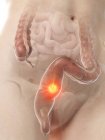 Рак толстой кишки в женском теле, концептуальная компьютерная иллюстрация . — стоковое фото
