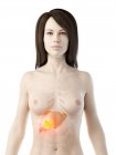 Cancro al fegato in realistico modello anatomico femminile, illustrazione concettuale del computer . — Foto stock