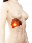 Câncer de fígado em modelo feminino anatômico realista, ilustração conceitual do computador . — Fotografia de Stock