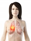 Cancro ai polmoni nel modello femminile realistico del corpo 3d, illustrazione concettuale del computer . — Foto stock