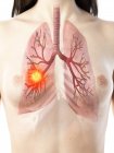 Lungenkrebs im weiblichen Körper 3D-Modell, konzeptionelle Computerillustration. — Stockfoto