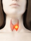 Cancro alla tiroide nel corpo femminile, illustrazione concettuale del computer . — Foto stock