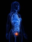 Cancro alla vescica nella silhouette del corpo umano, illustrazione digitale concettuale . — Foto stock