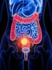 Cancer de l'intestin dans le corps féminin, illustration conceptuelle par ordinateur . — Photo de stock