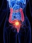 Рак кишечника в женском теле, концептуальная компьютерная иллюстрация
. — стоковое фото