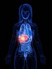 Рак печінки в абстрактному жіночому тілі, концептуальна комп'ютерна ілюстрація . — стокове фото
