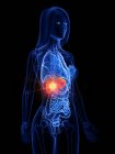 Рак печінки в абстрактному жіночому тілі, концептуальна комп'ютерна ілюстрація . — стокове фото
