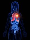 Cáncer de pulmón en el cuerpo transparente femenino, ilustración conceptual por computadora
. - foto de stock