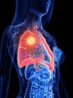 Câncer de pulmão no corpo transparente feminino, ilustração conceitual do computador . — Fotografia de Stock