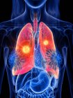 Рак легень у жіночому прозорому тілі, концептуальна комп'ютерна ілюстрація . — стокове фото